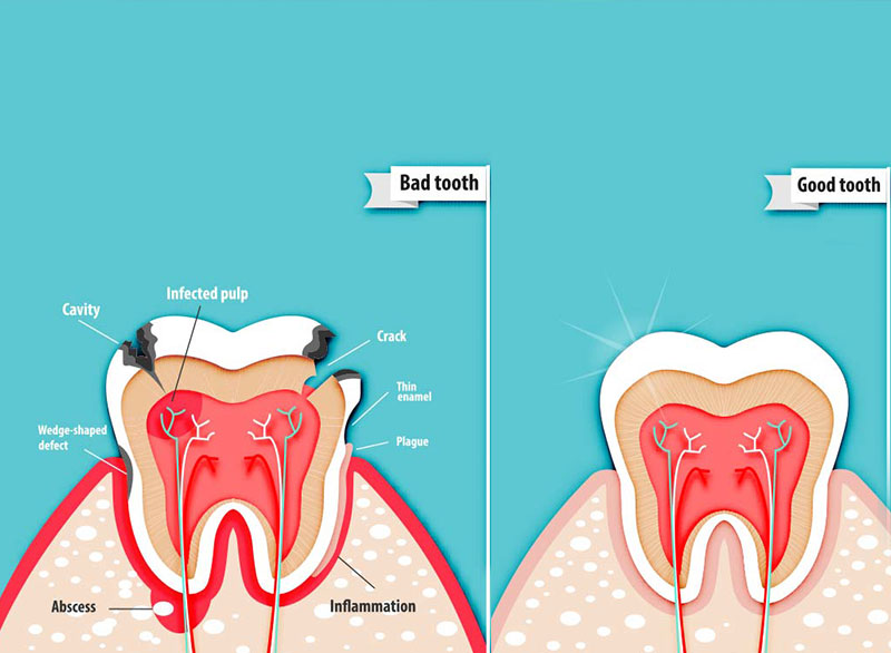 Botulinum Toxin