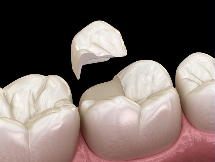 Advanced Tooth Repair (Inlays & Onlays)