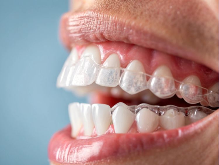 Advanced Tooth Repair (Inlays & Onlays)